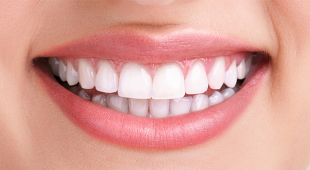 Tooth- Whitening