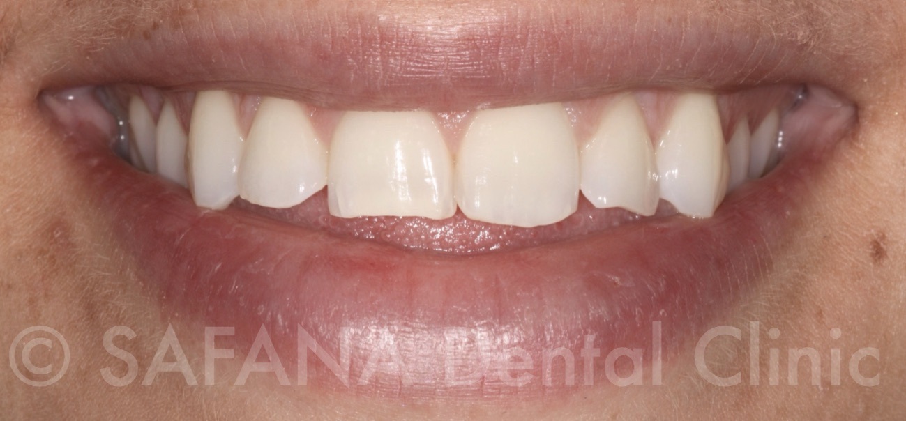 Aesthetic Composite Overlay Veneers