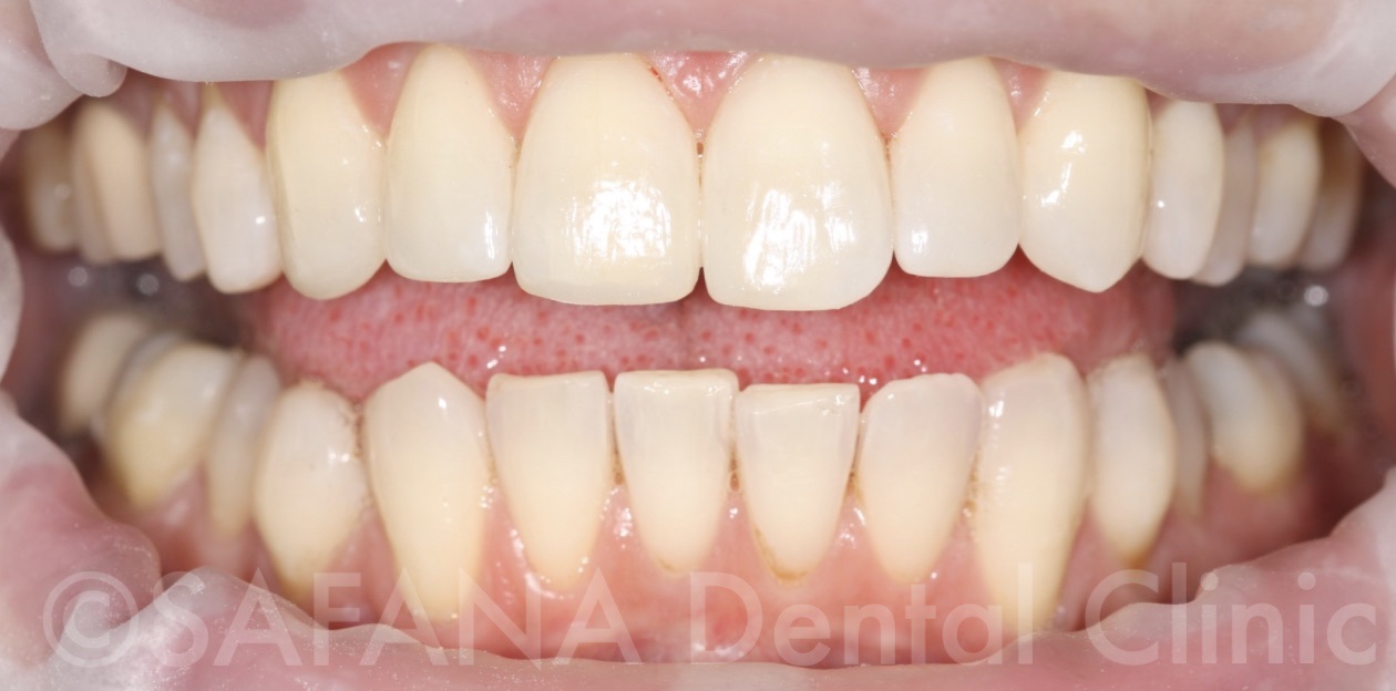 Aesthetic Composite Overlay Veneers