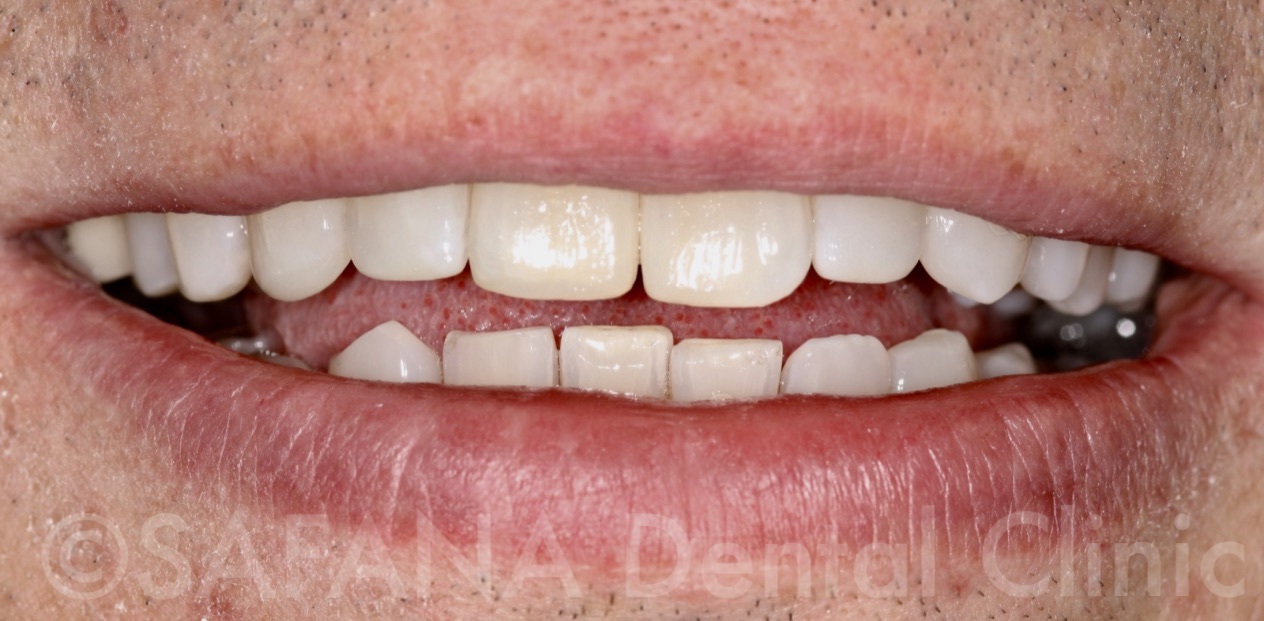 Aesthetic Composite Overlay Veneers