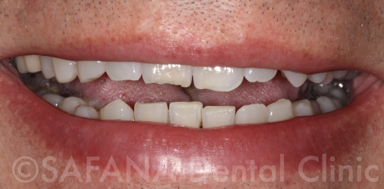 Aesthetic Composite Overlay Veneers