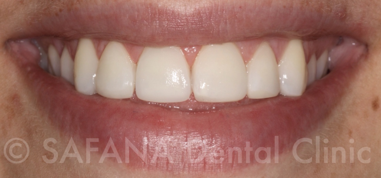 Aesthetic Composite Overlay Veneers