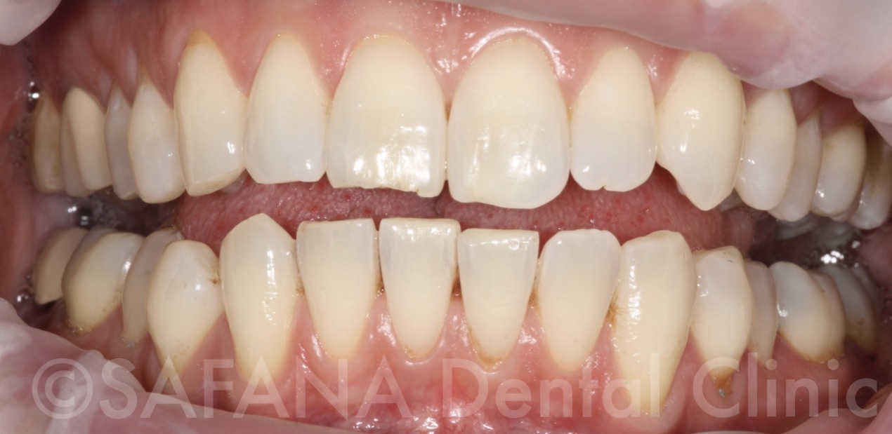 Aesthetic Composite Overlay Veneers